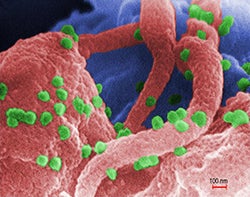 A colorized microscope image of numerous HIVs on a lymphocyte (white blood cell).